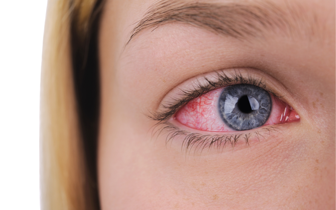 Začervenalé oko může značit zánět spojivek.